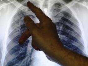 ٢٣ الف إصابة بداء السل في الجزائر و دليل طبي للتكفل بهذا الداء
