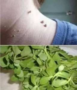 إلى من يعاني من وجود #الثآليل في جسمه