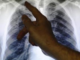 ٢٣ الف إصابة بداء السل في الجزائر و دليل طبي للتكفل بهذا الداء