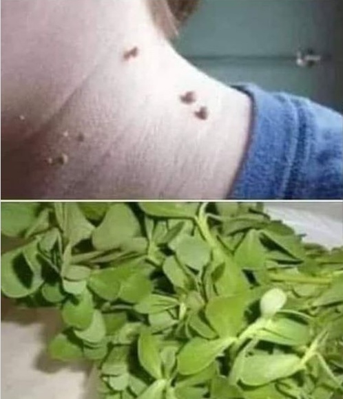 إلى من يعاني من وجود #الثآليل في جسمه