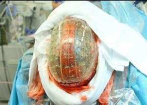 Première prothèse crânienne 3D 100% Algérienne !