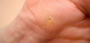 علاج مسمار القدم