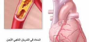 اعراض مرض القلب