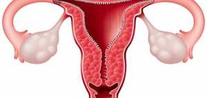 علاج ضعف المبايض