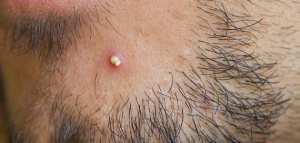 علاج الخراج