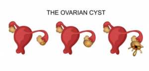 أعراض تكيس المبايض