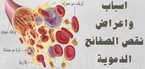 ما هو سبب نقص الصفائح الدموية