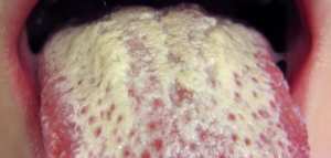 لماذا يصبح اللسان أبيض