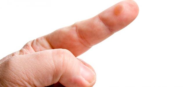 علاج الدمامل