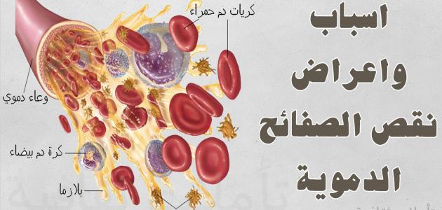 ما هو سبب نقص الصفائح الدموية