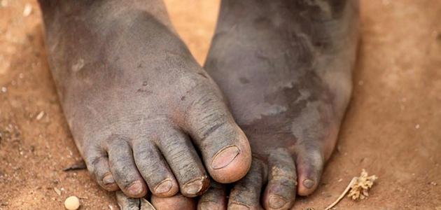 أسباب الفقر