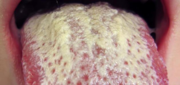 لماذا يصبح اللسان أبيض