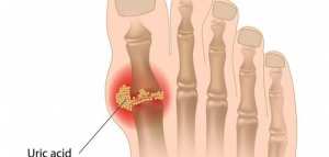 علاج النقرص