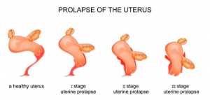 ما هو هبوط الرحم