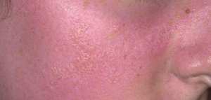 علاج ما بعد الحروق