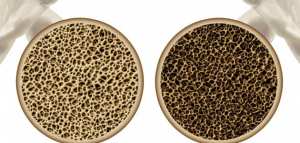 ما أعراض هشاشة العظام