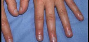 كيفية علاج بونتاف