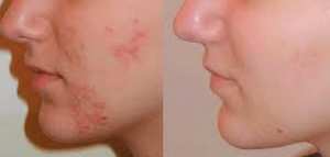 طرق تصفية الوجه