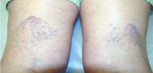 الليزر الوريدي و التردد الحراري في علاج دوالي الساقين