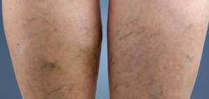 ما هي حقن التصليب لعلاج الدوالي