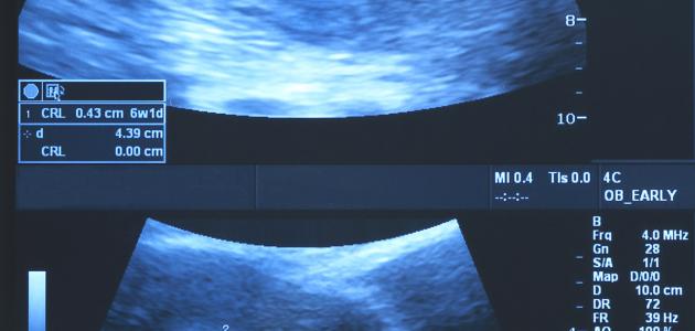 أعراض الحمل في الشهر الأول