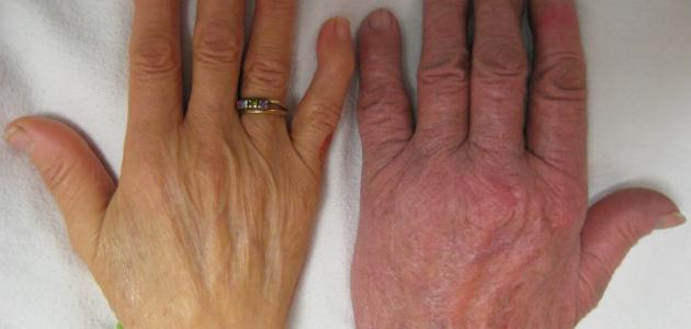 تعريف فقر الدم