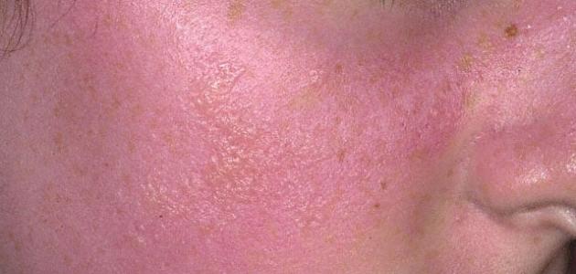 علاج ما بعد الحروق