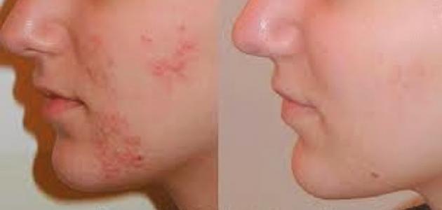 طرق تصفية الوجه