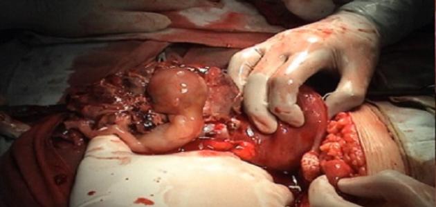 كيف يتم تشخيص الحمل خارج الرحم