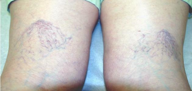 الليزر الوريدي و التردد الحراري في علاج دوالي الساقين