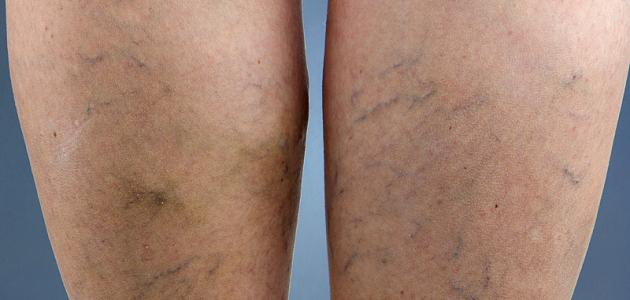 ما هي حقن التصليب لعلاج الدوالي