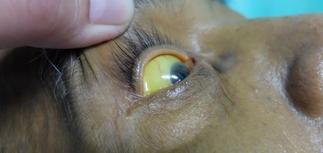 ما هي أعراض مشاكل الكبد