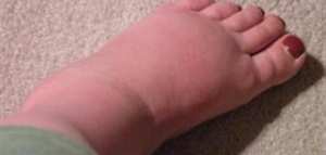 ما هي أسباب تورم القدمين