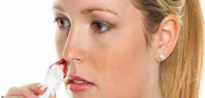 أسباب نزيف الأنف المفاجئ