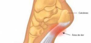 كيفية علاج العظمة الشوكية