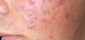 أين يظهر الطفح الجلدي لمرض الإيدز