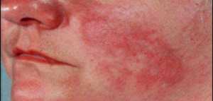 الذئبة الحمراء