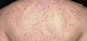 ظهور الحبوب في الجسم