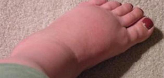 ما هي أسباب تورم القدمين