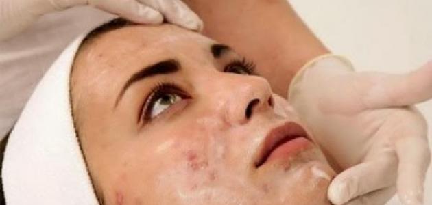 ما حل حب الشباب