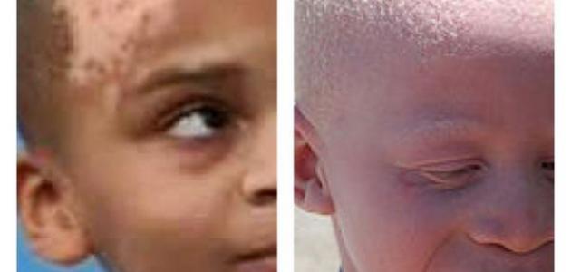 الفرق بين البهاق والبرص