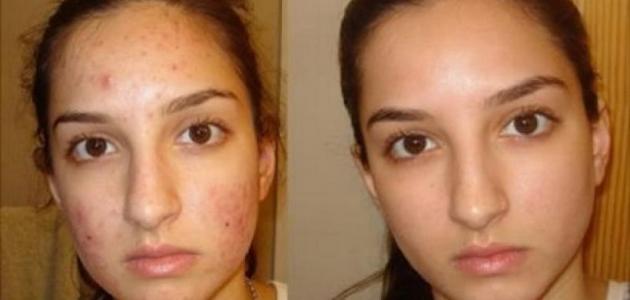 إزالة آثار حب الشباب في يومين