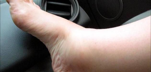 أسباب تورم القدم اليسرى