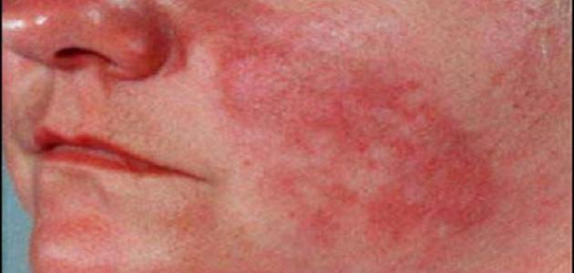 الذئبة الحمراء