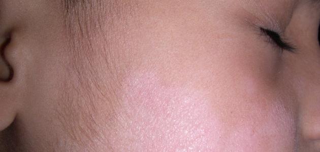 البقع البيضاء على الوجه