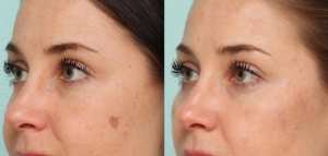 التخلص من البقع السوداء