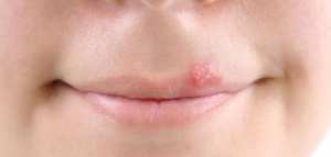علاج الحبوب حول الفم