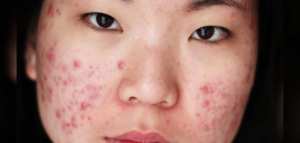 أنواع حب الشباب