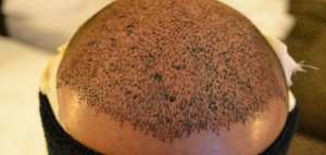 أحدث طرق زراعة الشعر