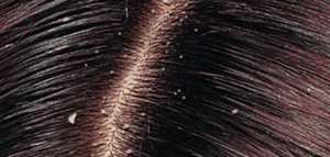 كيف ينتقل القمل والصيبان